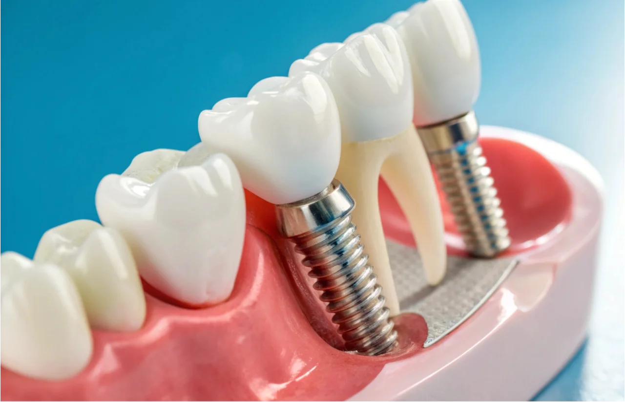 3D illustration of dental implant showing implant post, abutment, and crown components in gum tissue