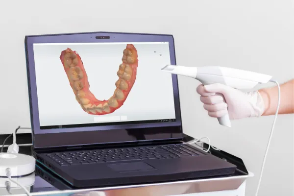 iTero digital scanner displaying 3D dental impression on laptop screen