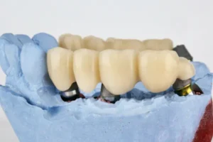 Porcelain dental bridge restoration on model showing multiple connected crowns