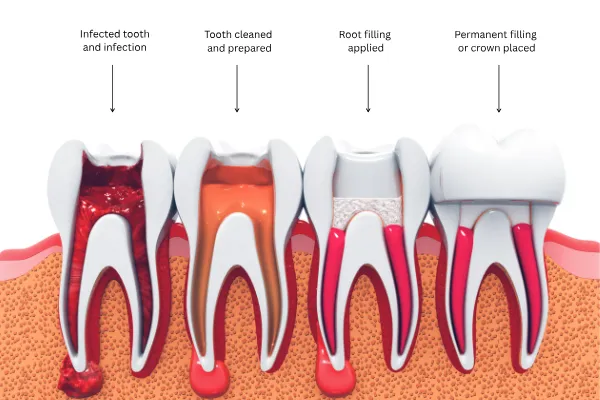 Cross-section diagram showing root canal procedure steps from infected tooth to final restoration
