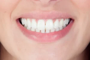 Close-up of healthy smile showing straight white teeth