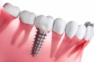 3D illustration of dental implant post integrated into jawbone between natural teeth