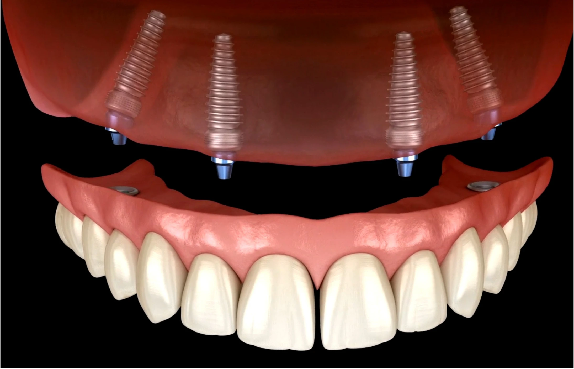 3d illustration showing all on 4 dental implant procedure