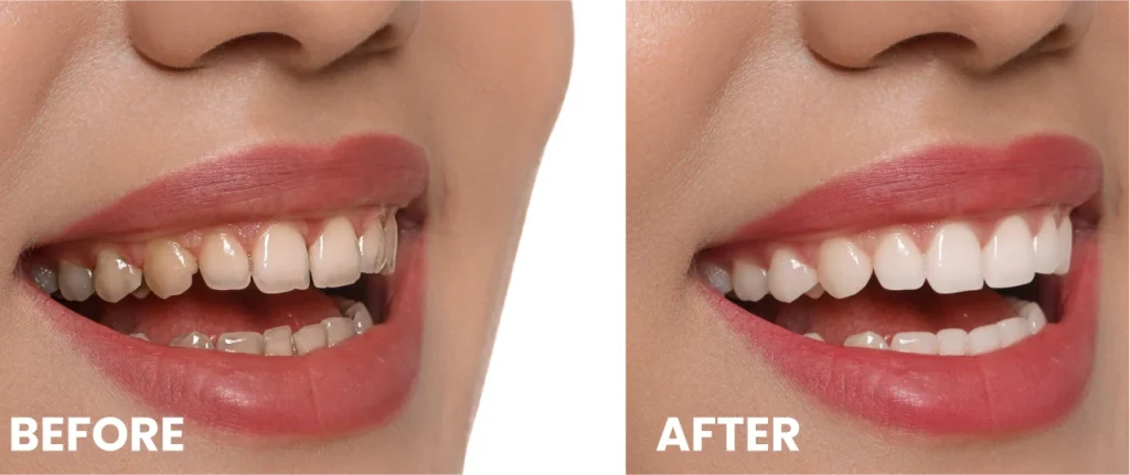 Split before and after comparison of smile showing dental bonding results on front teeth