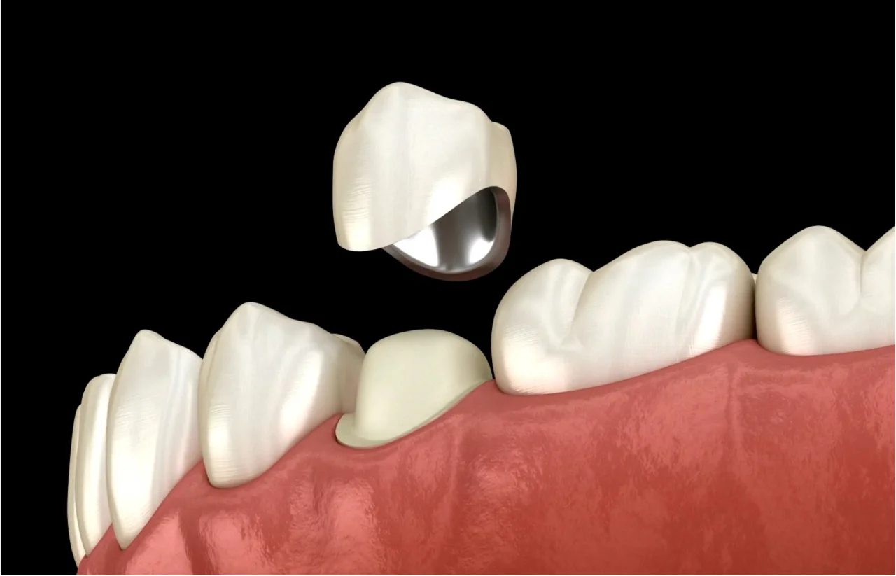 Alt Text: 3D illustration of dental crown being placed on tooth in gum tissue on black background