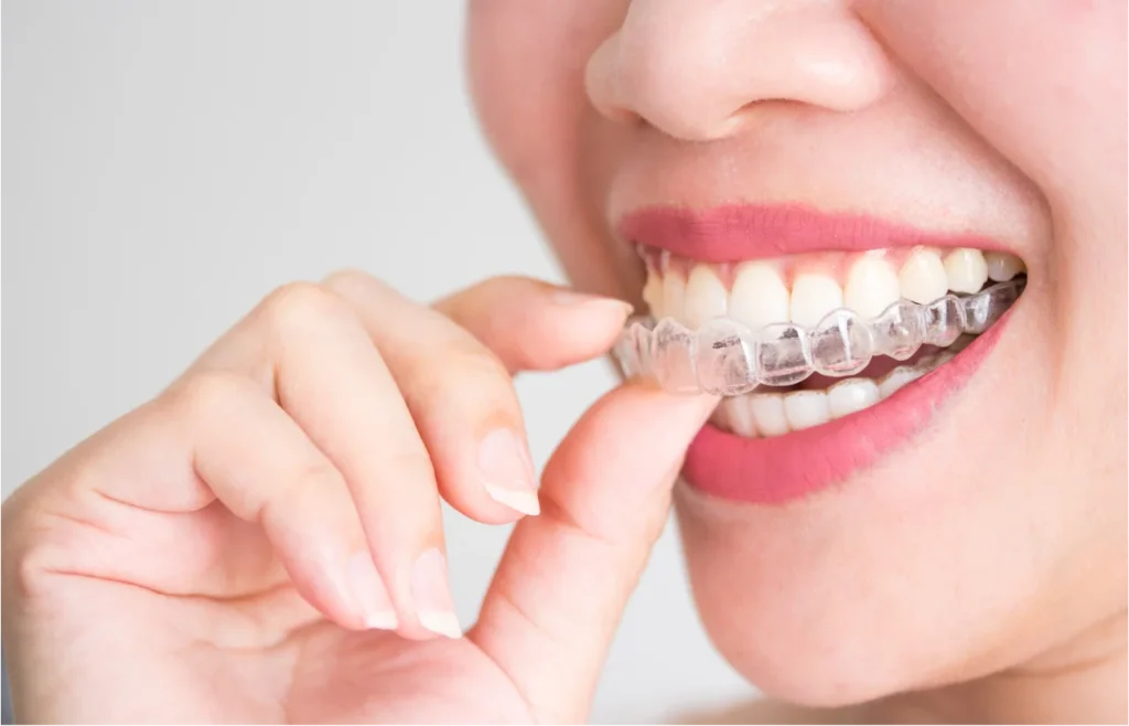 Hand holding clear Invisalign aligner over smile showing teeth