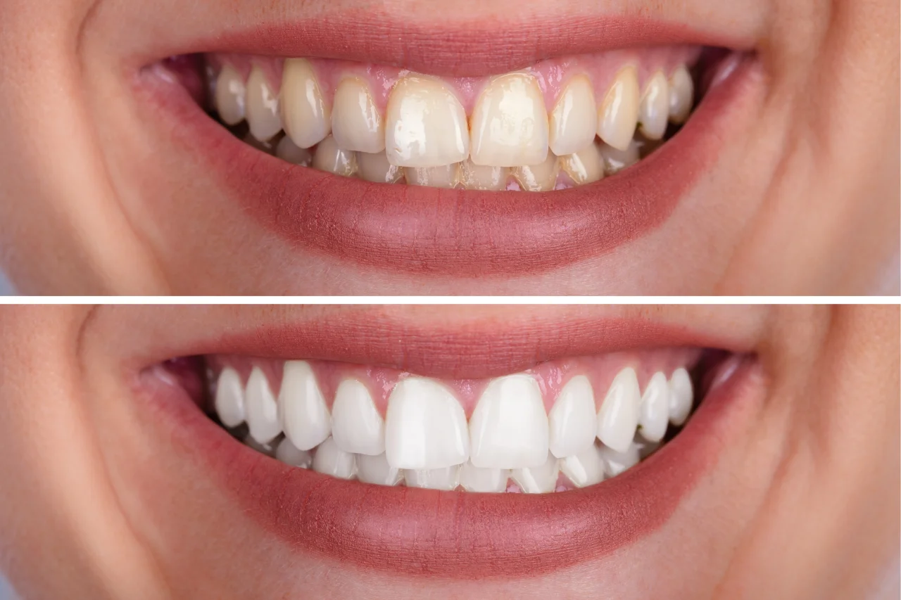Before and after comparison showing discolored teeth transformed to bright white smile