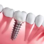 Dental implant post placed in jawbone showing tooth replacement tacoma wa procedure at Davis Dental Group