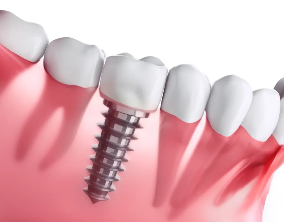 Dental implant post placed in jawbone showing tooth replacement tacoma wa procedure at Davis Dental Group