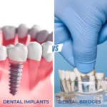 Side by side comparison of dental implants and dental bridges tacoma wa at Davis Dental Group