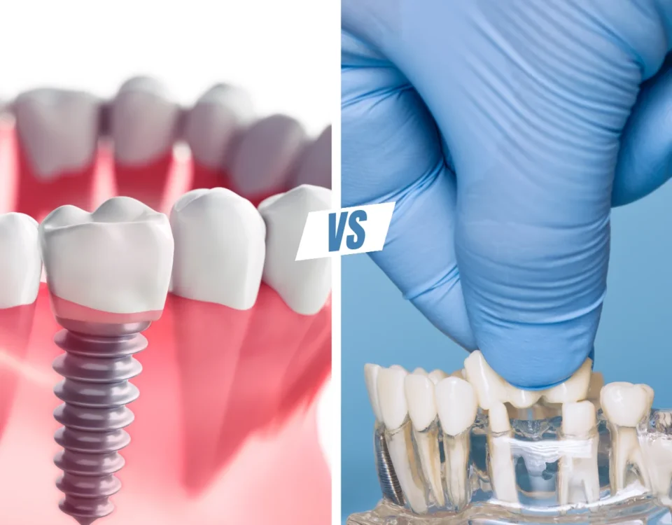 Side by side comparison of dental implants and dental bridges tacoma wa at Davis Dental Group