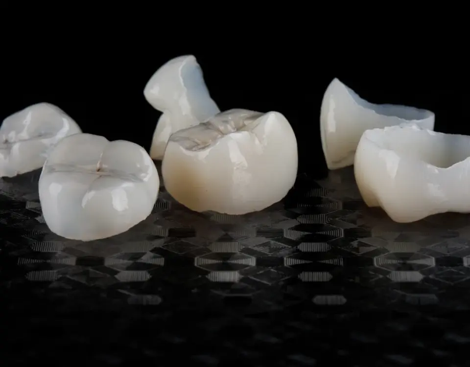 Porcelain crowns displayed before placement at Davis Dental Group offering tacoma dental crowns