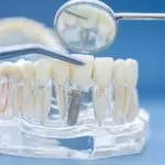Dental model showing dentures and implants comparison at Davis Dental Group in Tacoma WA