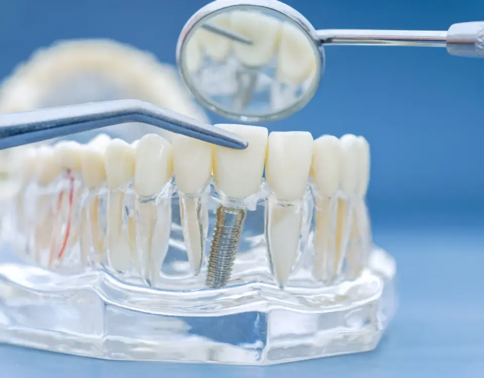 Dental model showing dentures and implants comparison at Davis Dental Group in Tacoma WA