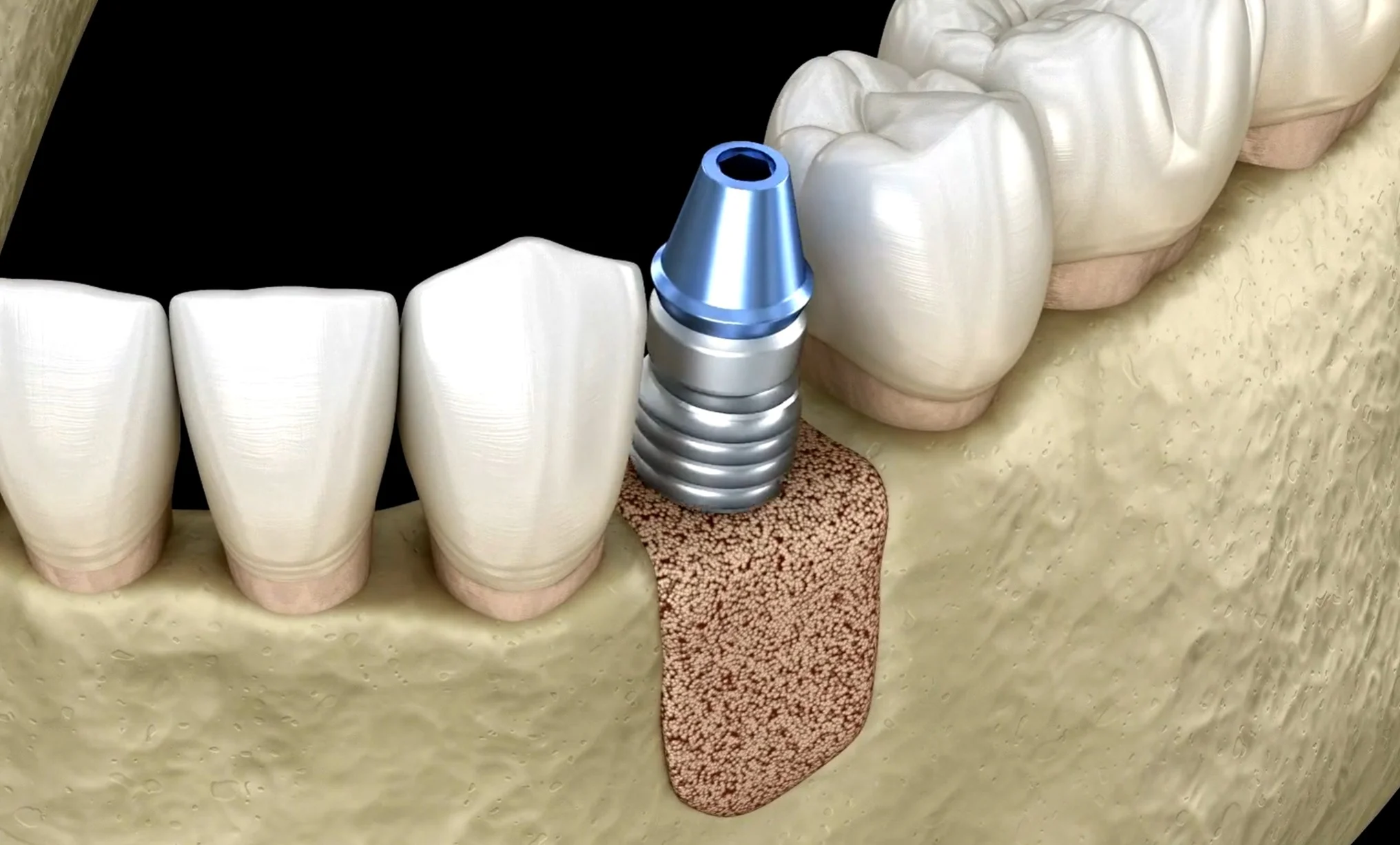 Bone graft material supporting a dental implant with healing abutment before final crown placement