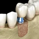 3D illustration showing dental bone graft material placed in the jawbone for bone grafting tacoma wa at Davis Dental Group