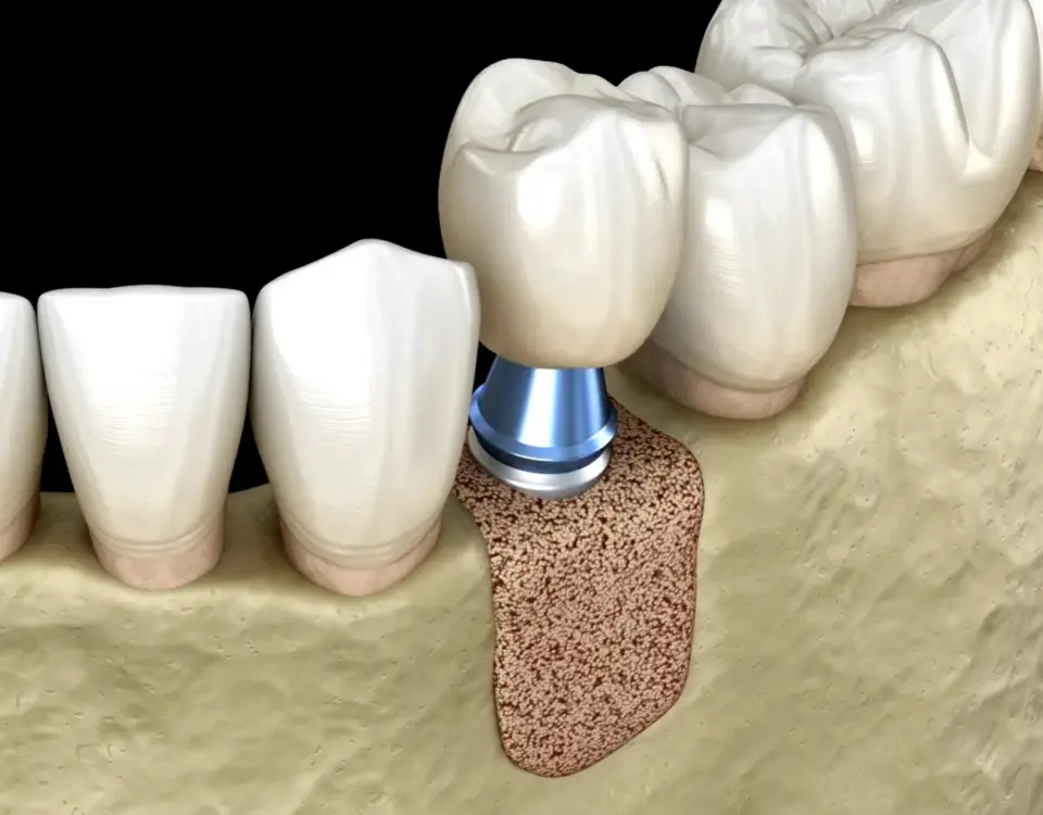 3D illustration showing dental bone graft material placed in the jawbone for bone grafting tacoma wa at Davis Dental Group