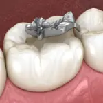 3D illustration of an old silver amalgam filling on a molar tooth representing fillings tacoma patients may need replaced at Davis Dental Group