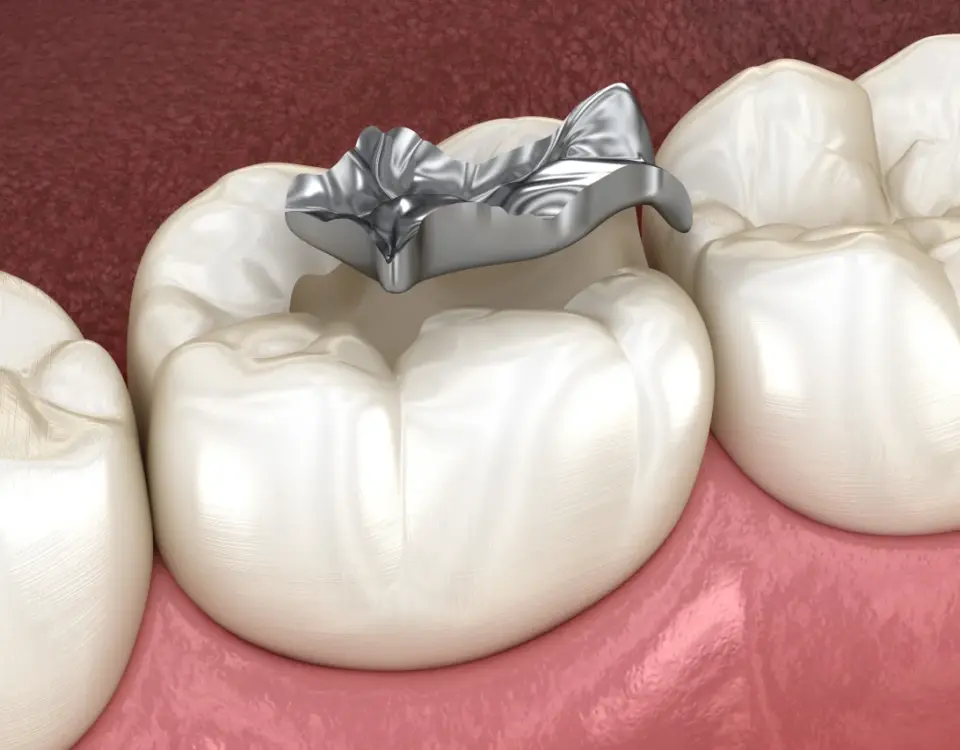 3D illustration of an old silver amalgam filling on a molar tooth representing fillings tacoma patients may need replaced at Davis Dental Group