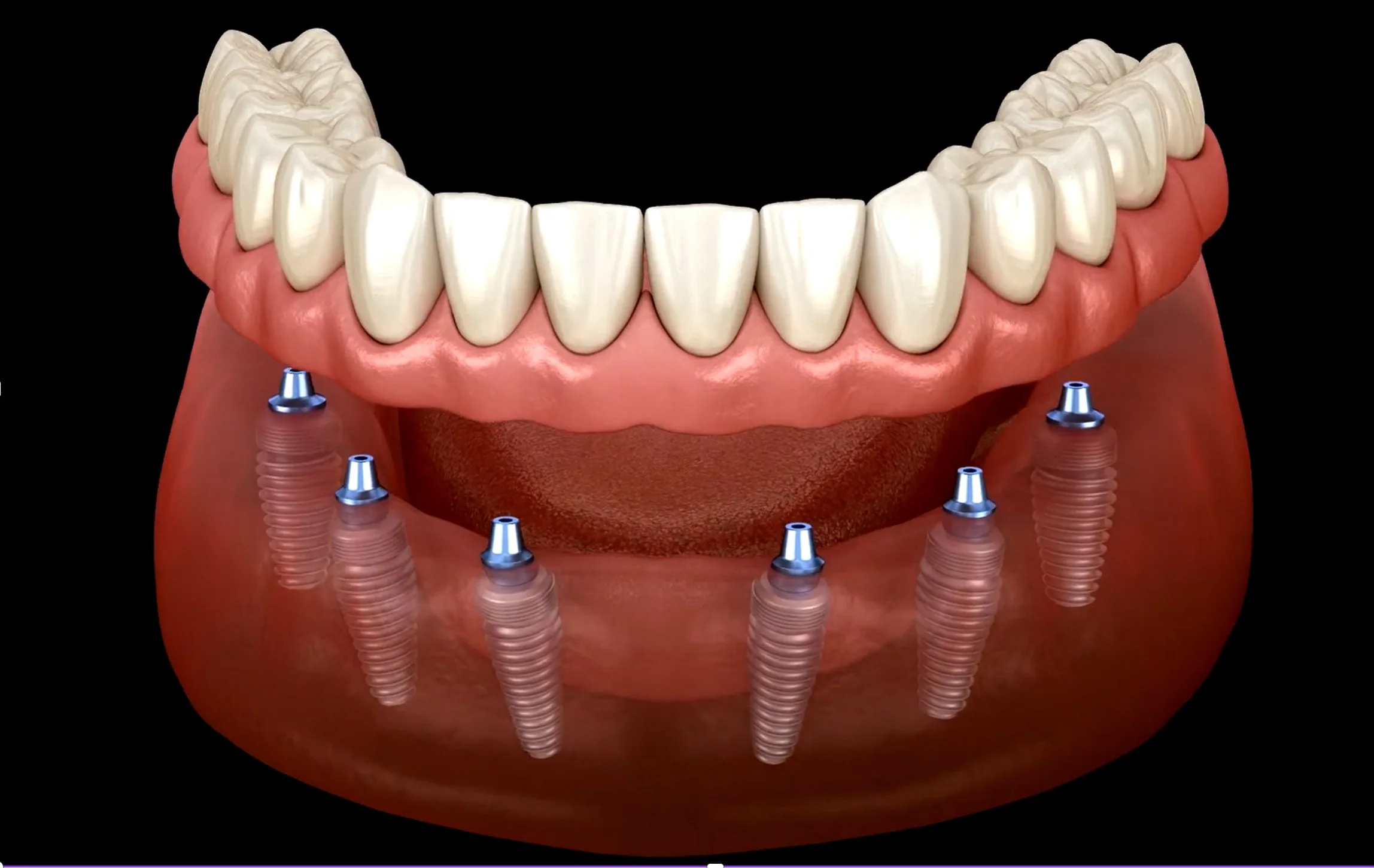 Full arch implant bridge with six dental implants supporting a full arch of replacement teeth