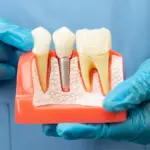 Dental implant model held by gloved hands