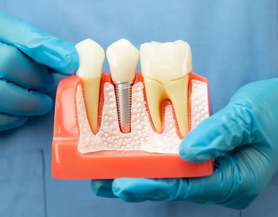 Dental implant model held by gloved hands