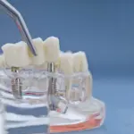 Dental bridge being placed on a jaw model showing implant posts — Davis Dental Group Tacoma WA