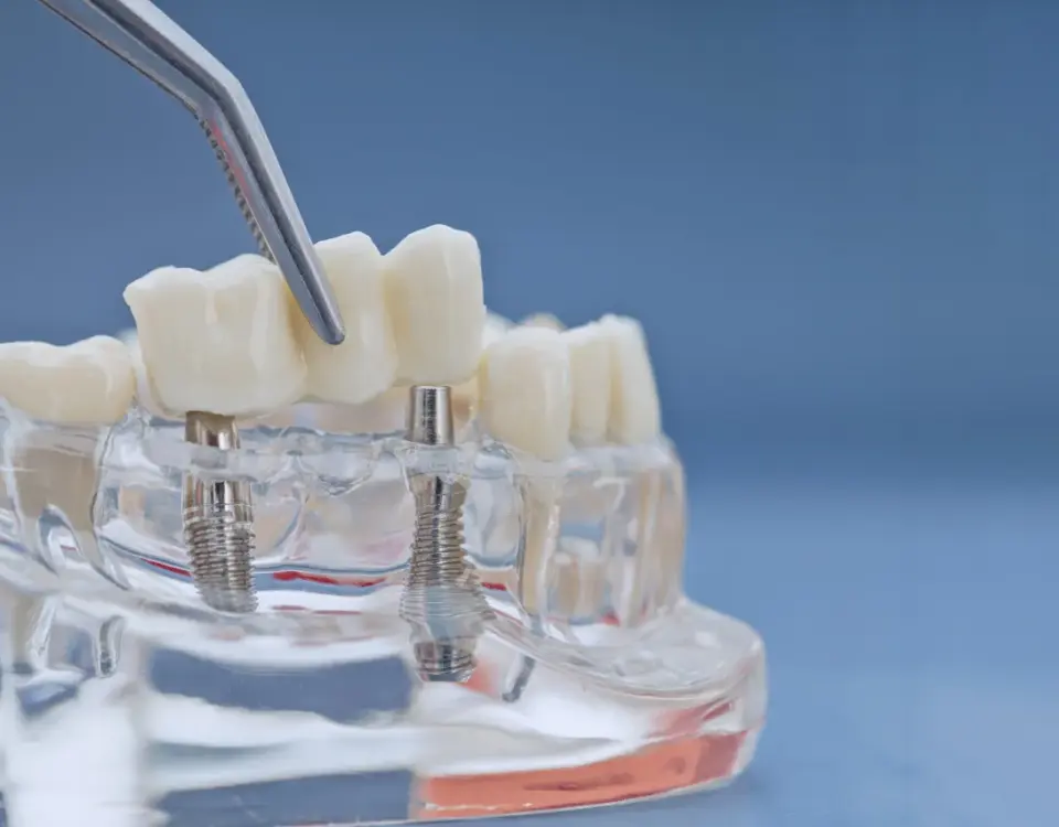 Dental bridge being placed on a jaw model showing implant posts — Davis Dental Group Tacoma WA