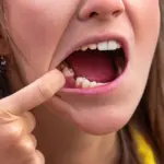 Woman pointing to missing tooth gap showing concern about dental implant timeline at Davis Dental Group in Tacoma