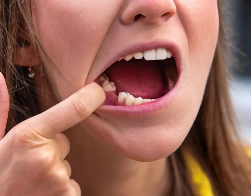 Woman pointing to missing tooth gap showing concern about dental implant timeline at Davis Dental Group in Tacoma
